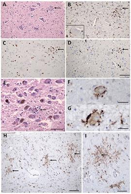 Imaging and neuropathological findings in patients with Post COVID-19 Neurological Syndrome—A review